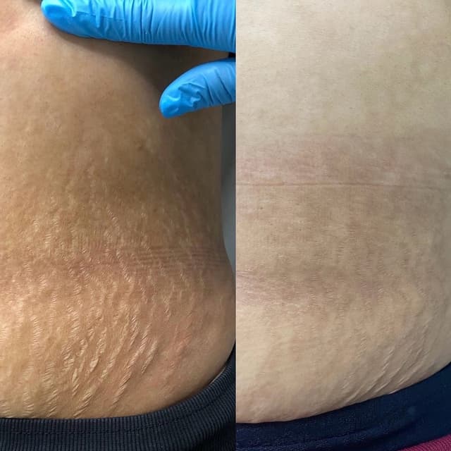 Stretch Mark Revision – 3 Sessions at Studio PrimaVera in Roswell, GA